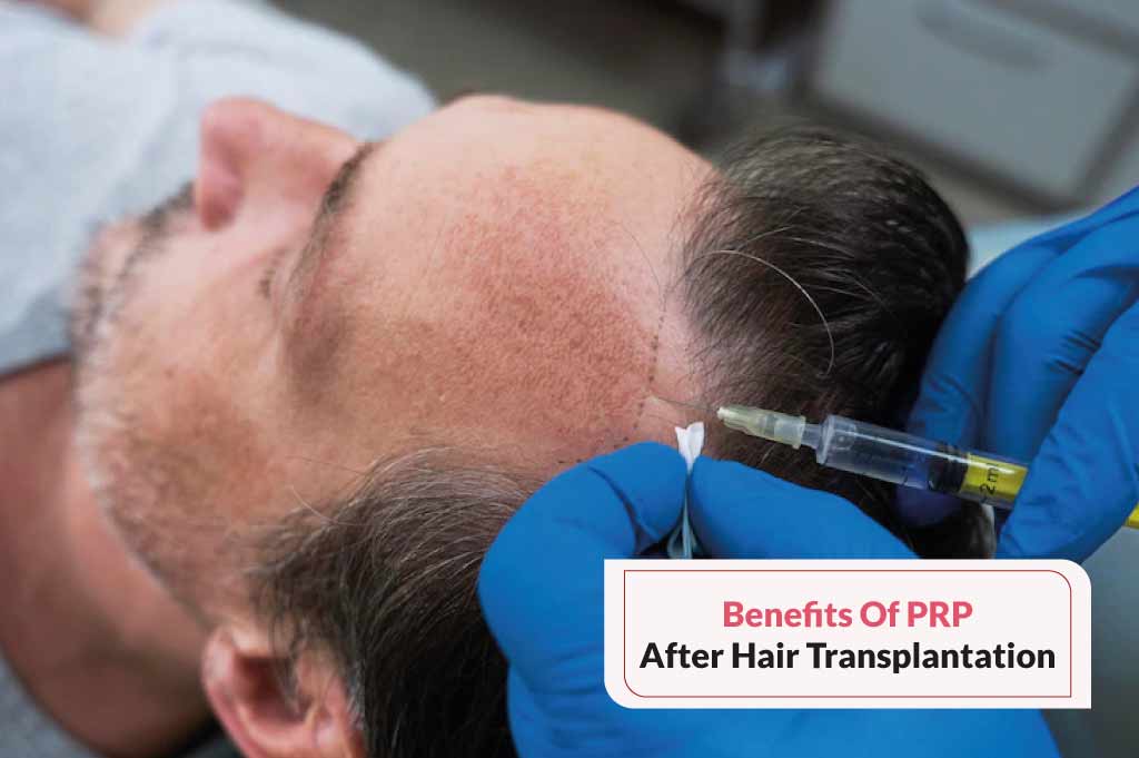 Prp After Hair Transplant